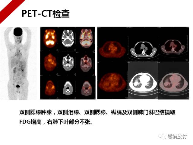 【病例】IgG4​相关性疾病1例PET/CT影像表现