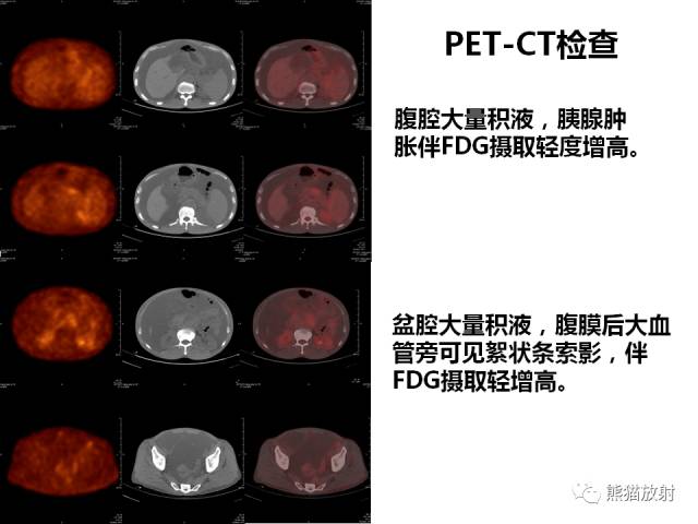 【病例】IgG4​相关性疾病1例PET/CT影像表现