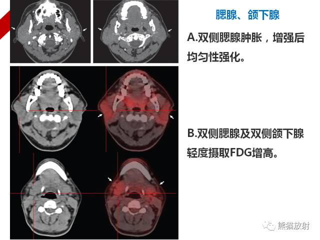 【病例】IgG4​相关性疾病1例PET/CT影像表现