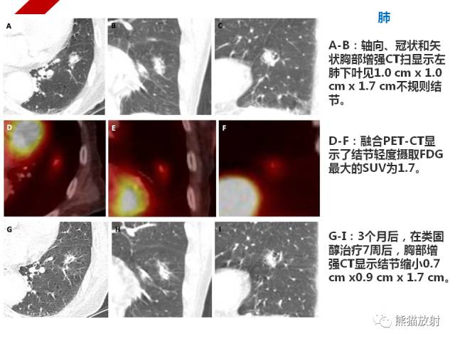 【病例】IgG4​相关性疾病1例PET/CT影像表现