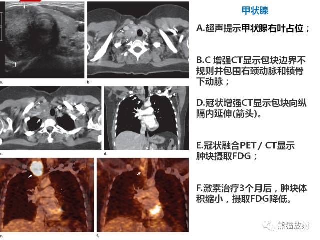 【病例】IgG4​相关性疾病1例PET/CT影像表现