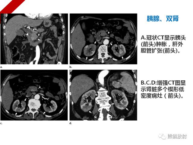 【病例】IgG4​相关性疾病1例PET/CT影像表现