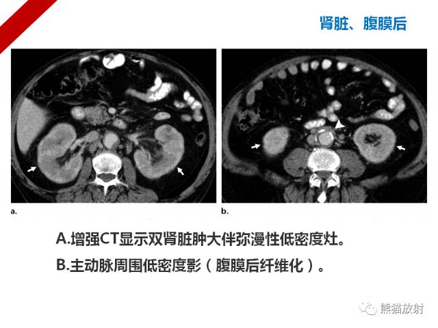 【病例】IgG4​相关性疾病1例PET/CT影像表现