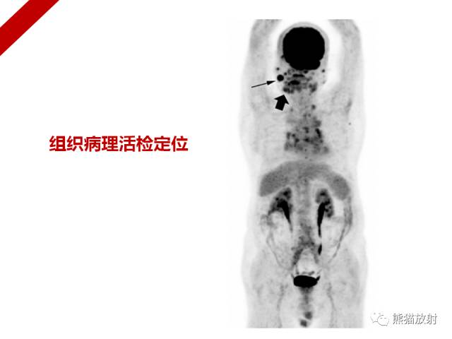 【病例】IgG4​相关性疾病1例PET/CT影像表现