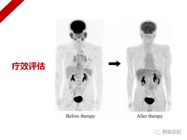 【病例】IgG4​相关性疾病1例PET/CT影像表现