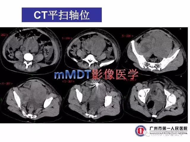 【病例】卵巢PNET1例CT及MR