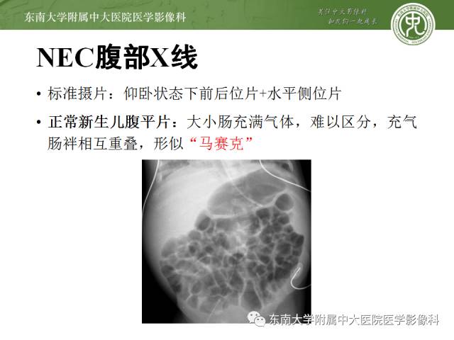 【病例】新生儿坏死性肠炎1例X线CT影像表现