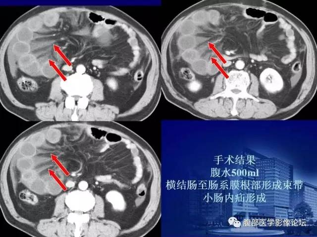【PPT】急性绞窄性肠梗阻CT诊断