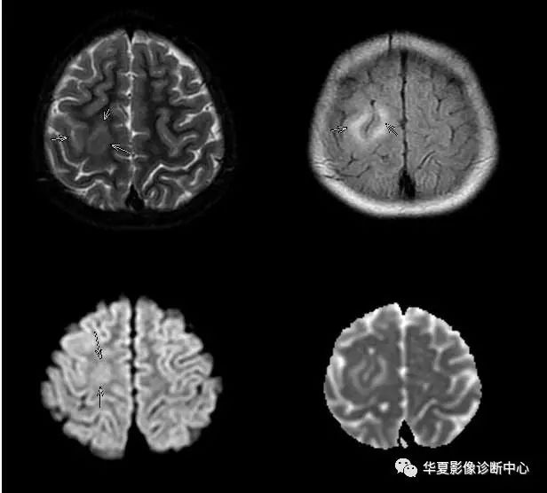 【病例】局灶性皮质发育不良FCD一例MR