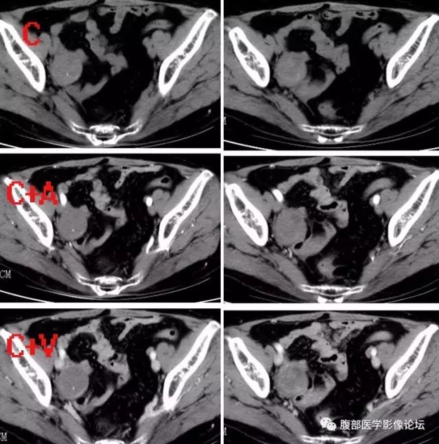 【病例】右侧卵巢甲状腺肿伴囊性变1例CT 【病例】右侧卵巢甲状腺肿伴囊性变1例CT