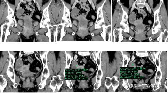 【病例】右侧卵巢甲状腺肿伴囊性变1例CT