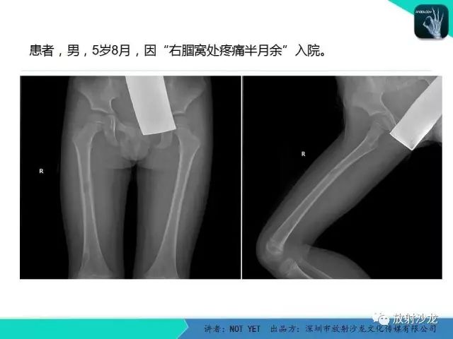 【病例】低毒性骨髓炎1例X线MR影像表现