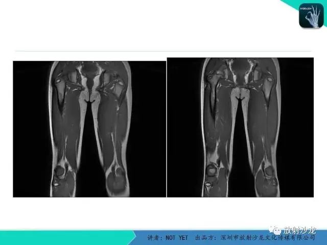 【病例】低毒性骨髓炎1例X线MR影像表现