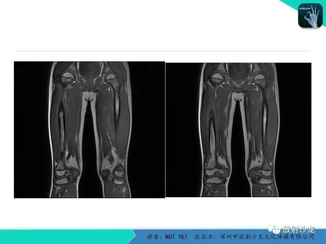 【病例】低毒性骨髓炎1例X线MR影像表现