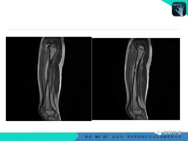 【病例】低毒性骨髓炎1例X线MR影像表现