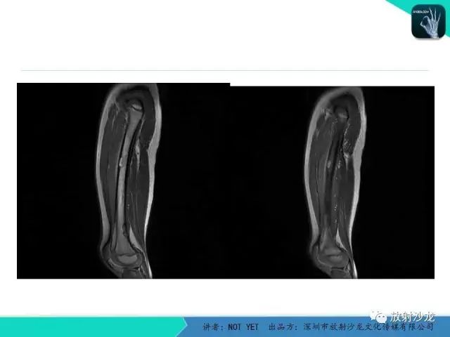 【病例】低毒性骨髓炎1例X线MR影像表现