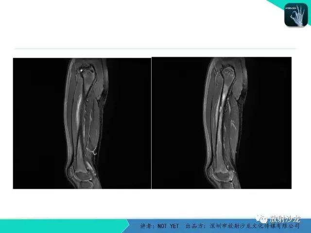 【病例】低毒性骨髓炎1例X线MR影像表现