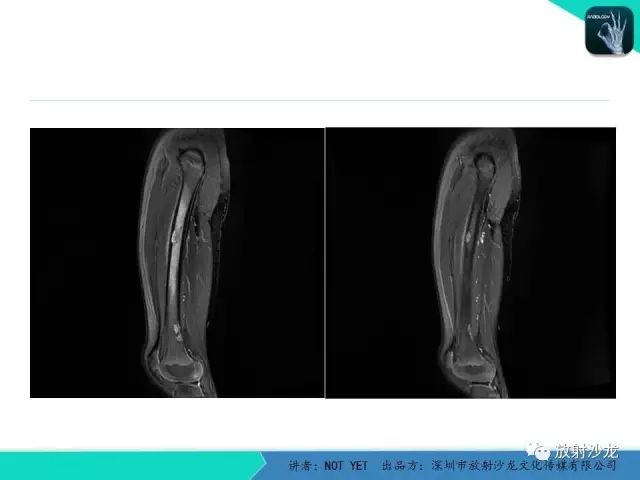 【病例】低毒性骨髓炎1例X线MR影像表现