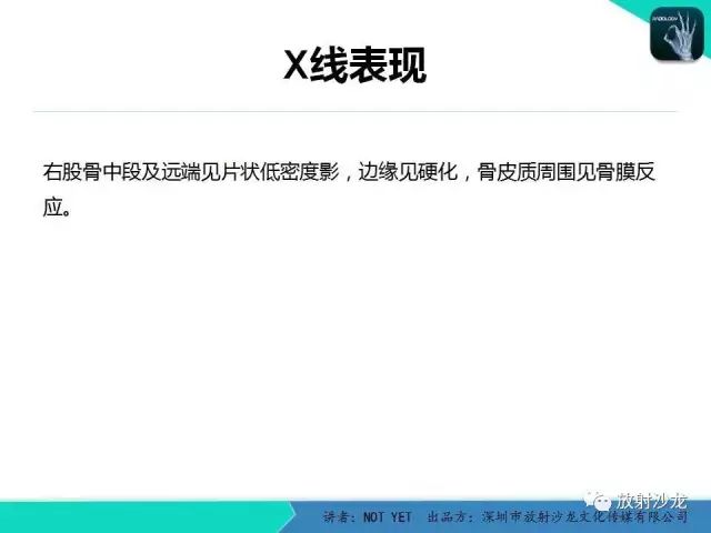 【病例】低毒性骨髓炎1例X线MR影像表现