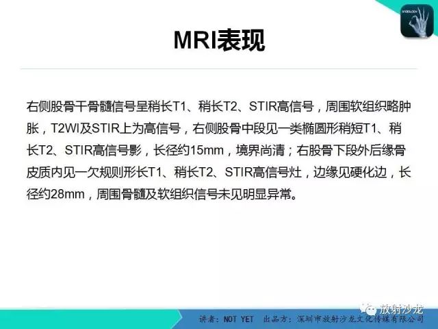 【病例】低毒性骨髓炎1例X线MR影像表现