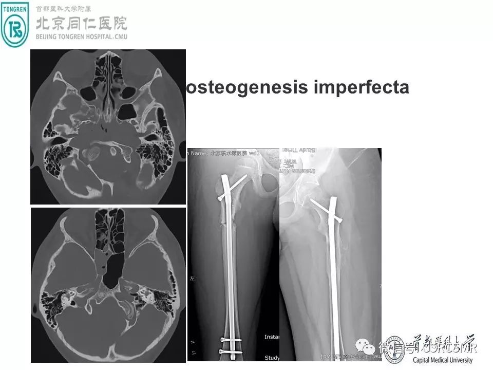 【PPT】颅底骨源性肿瘤影像学分析思路