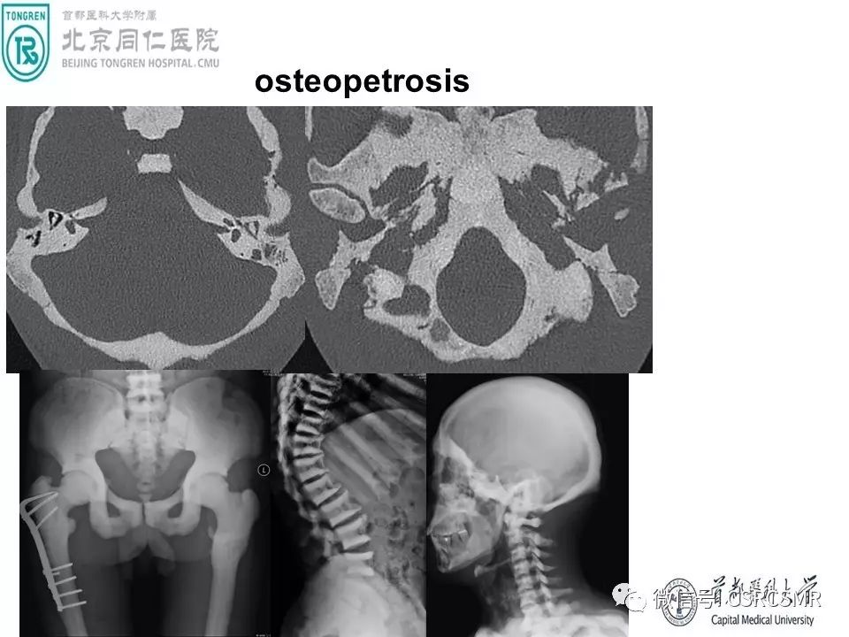 【PPT】颅底骨源性肿瘤影像学分析思路
