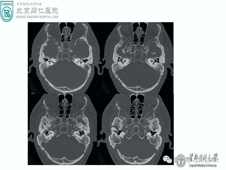 【PPT】颅底骨源性肿瘤影像学分析思路