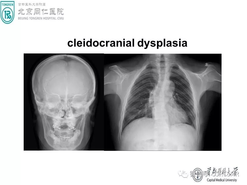 【PPT】颅底骨源性肿瘤影像学分析思路