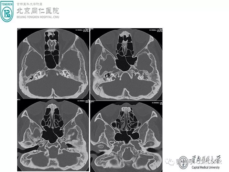 【PPT】颅底骨源性肿瘤影像学分析思路