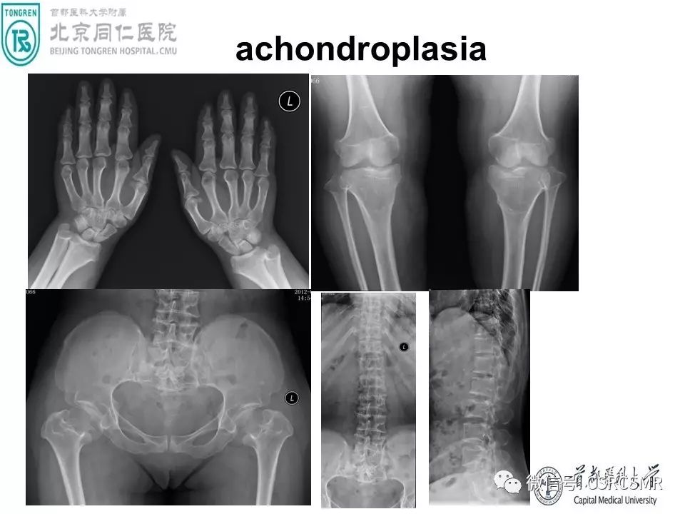【PPT】颅底骨源性肿瘤影像学分析思路