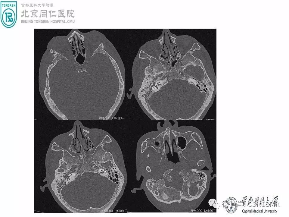 【PPT】颅底骨源性肿瘤影像学分析思路
