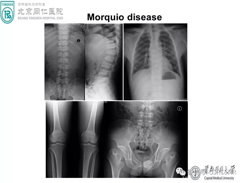 【PPT】颅底骨源性肿瘤影像学分析思路