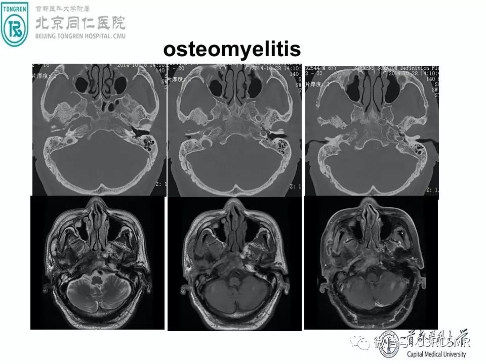 【PPT】颅底骨源性肿瘤影像学分析思路