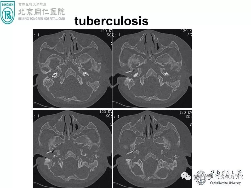 【PPT】颅底骨源性肿瘤影像学分析思路
