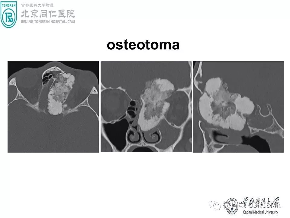 【PPT】颅底骨源性肿瘤影像学分析思路