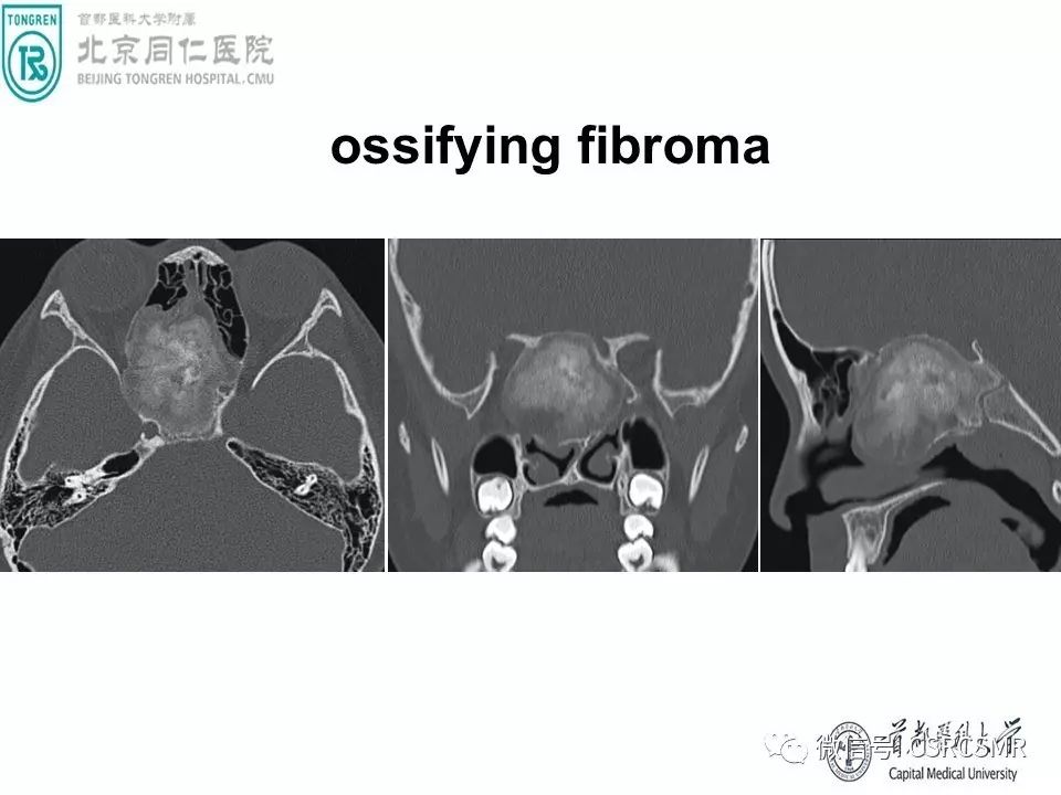 【PPT】颅底骨源性肿瘤影像学分析思路