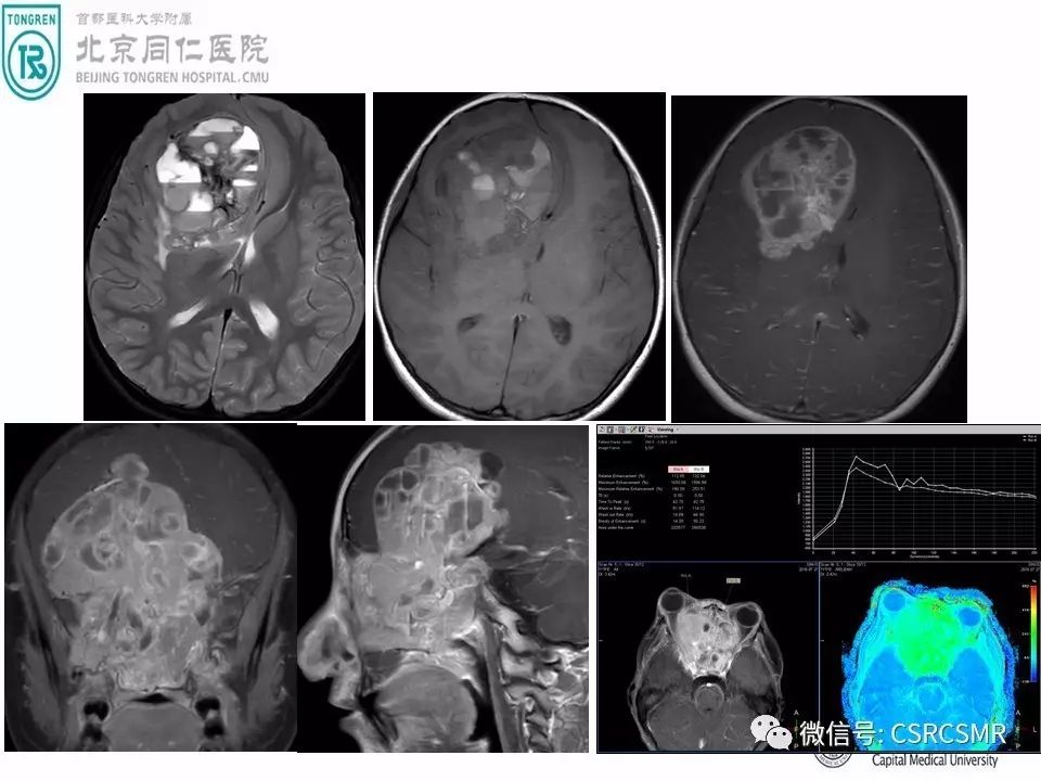 【PPT】颅底骨源性肿瘤影像学分析思路
