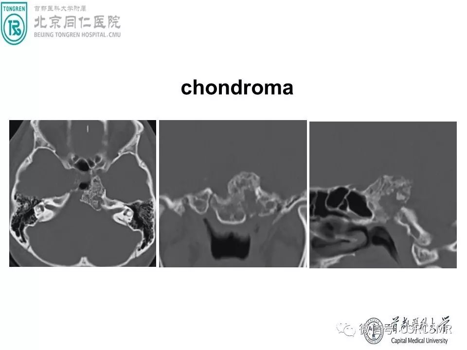 【PPT】颅底骨源性肿瘤影像学分析思路