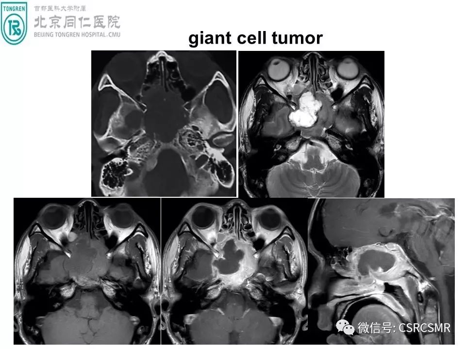 【PPT】颅底骨源性肿瘤影像学分析思路