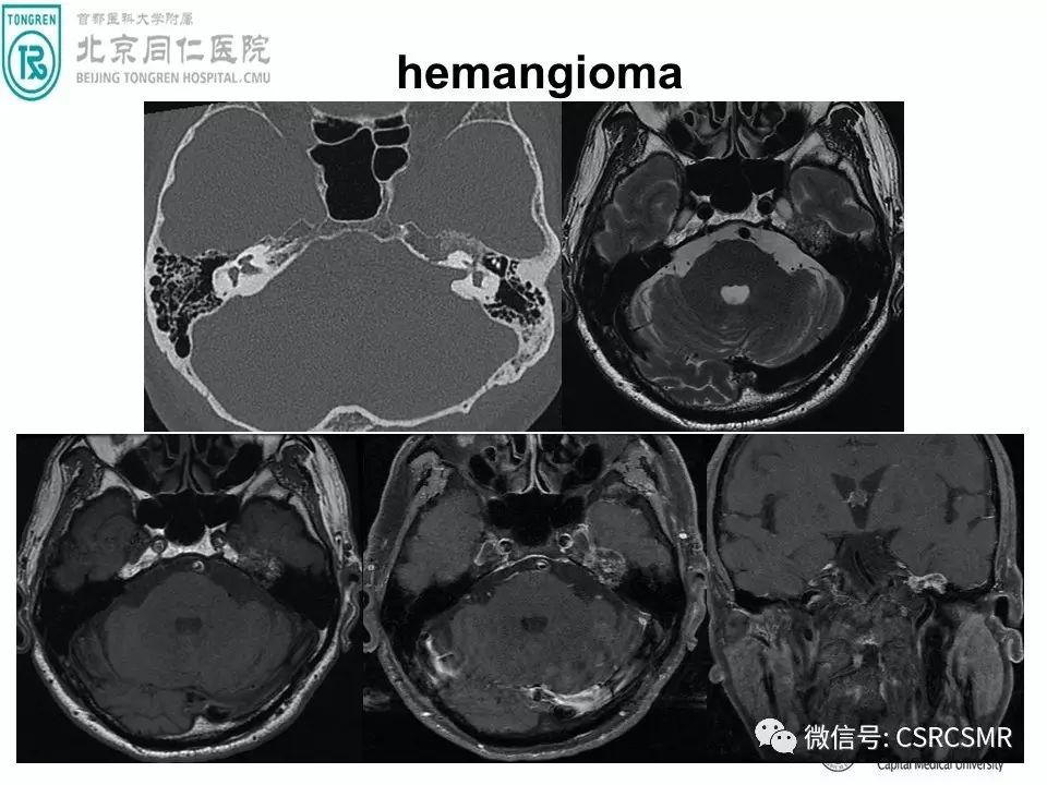 【PPT】颅底骨源性肿瘤影像学分析思路