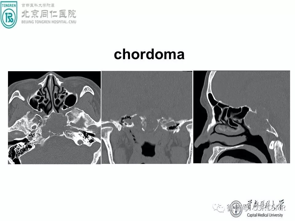 【PPT】颅底骨源性肿瘤影像学分析思路