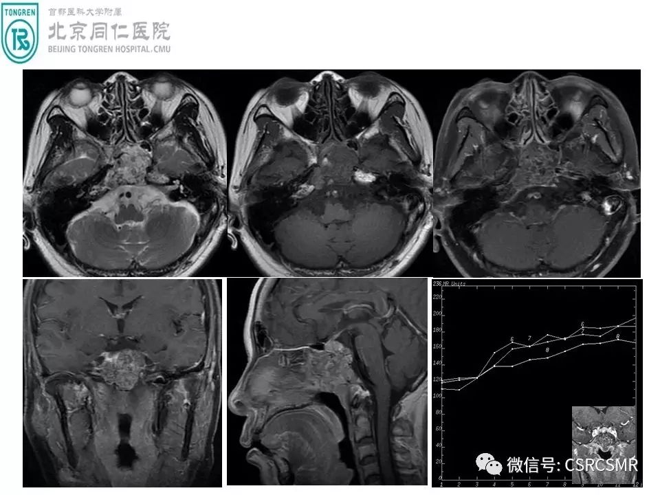 【PPT】颅底骨源性肿瘤影像学分析思路