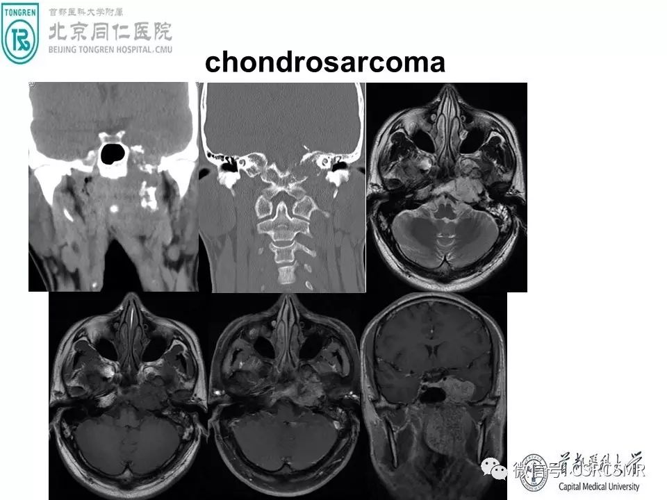 【PPT】颅底骨源性肿瘤影像学分析思路