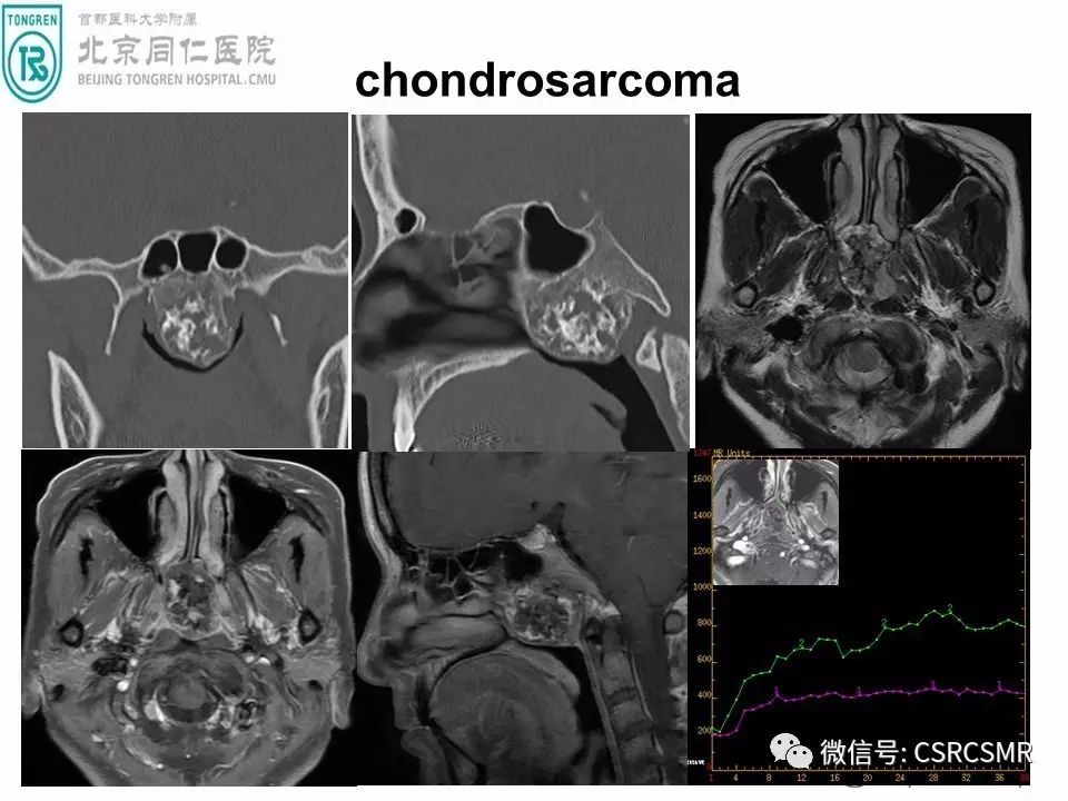 【PPT】颅底骨源性肿瘤影像学分析思路