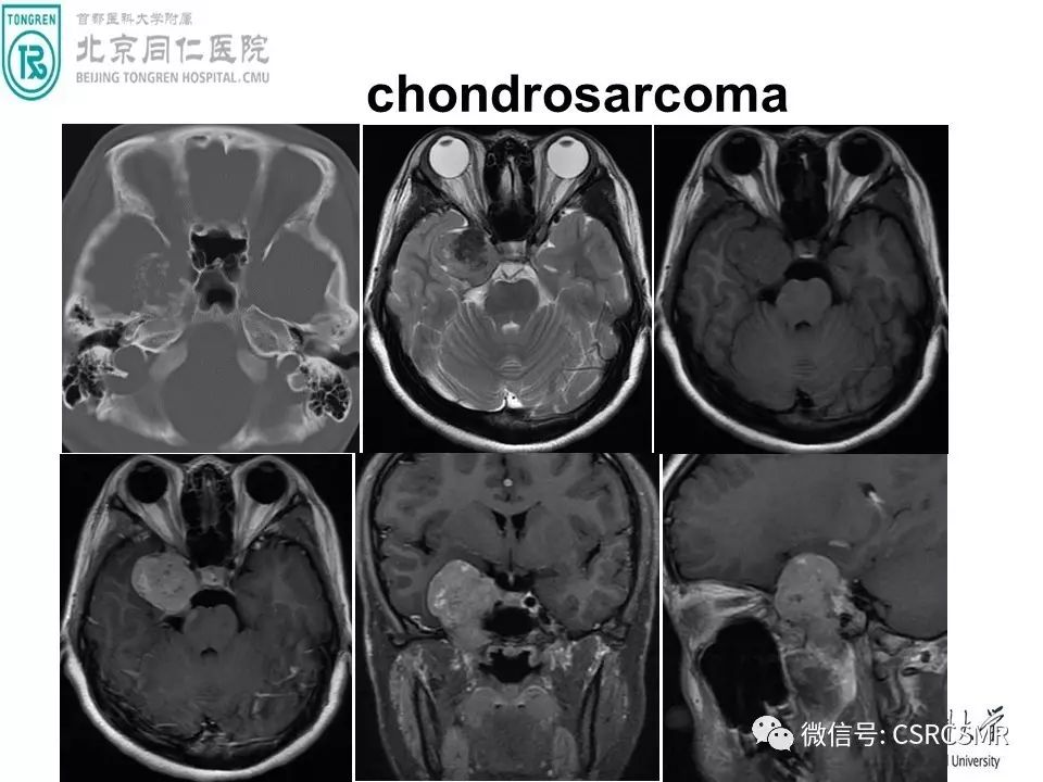 【PPT】颅底骨源性肿瘤影像学分析思路