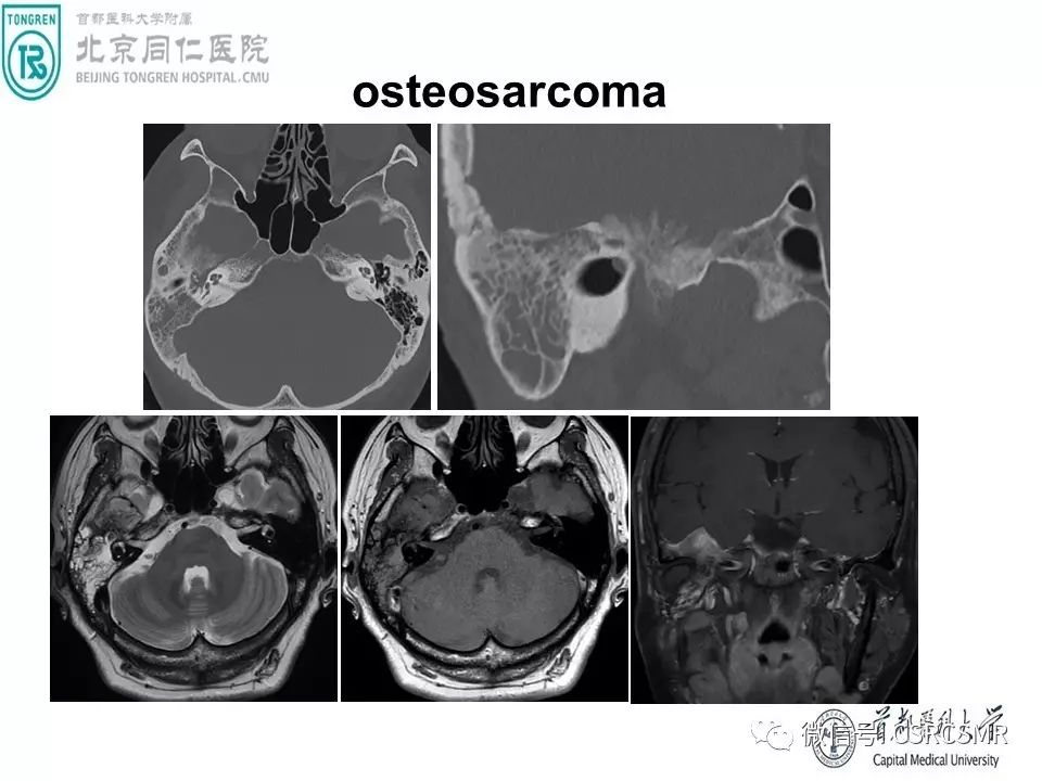 【PPT】颅底骨源性肿瘤影像学分析思路