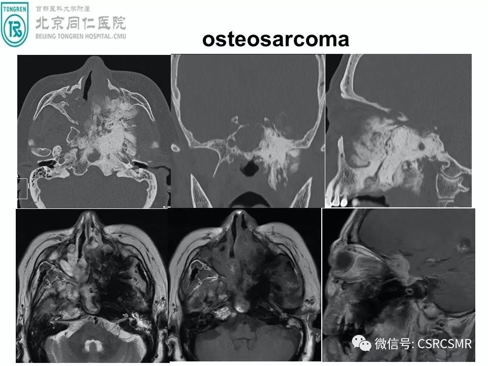 【PPT】颅底骨源性肿瘤影像学分析思路