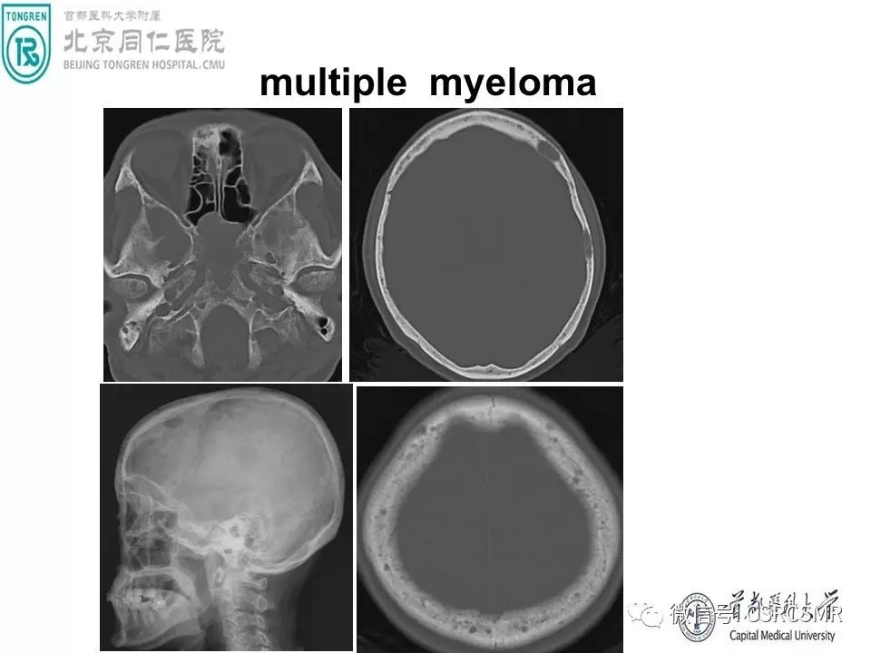 【PPT】颅底骨源性肿瘤影像学分析思路