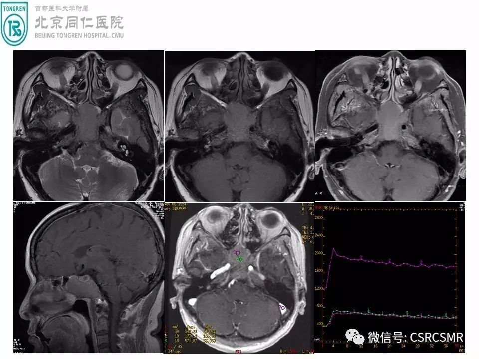 【PPT】颅底骨源性肿瘤影像学分析思路