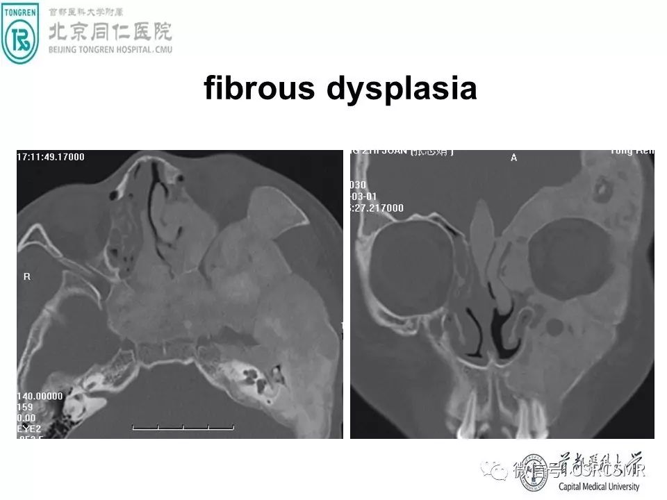 【PPT】颅底骨源性肿瘤影像学分析思路
